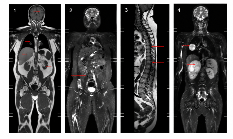 Vorsorge mittels Ganzkörper-MRT: KI-gestützte Früherkennung von Krankheiten in der Radiologie